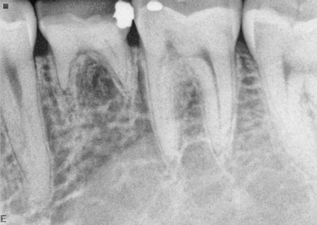 retained baby tooth