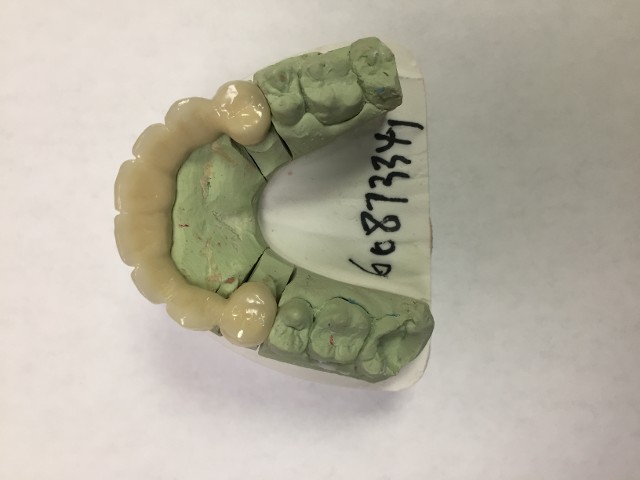 dental bridge