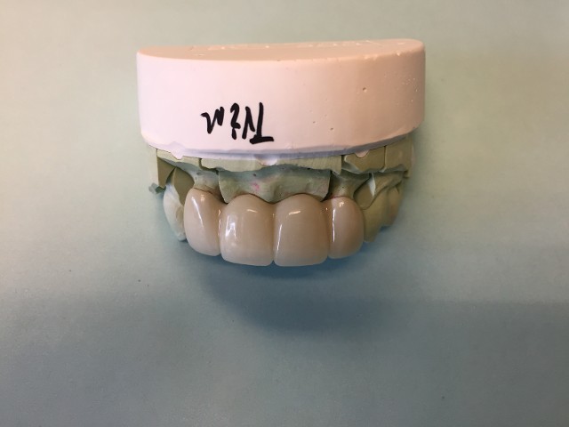 dental bridge dental bridge