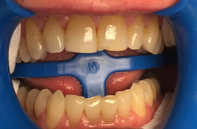 30% Carbamide Peroxide