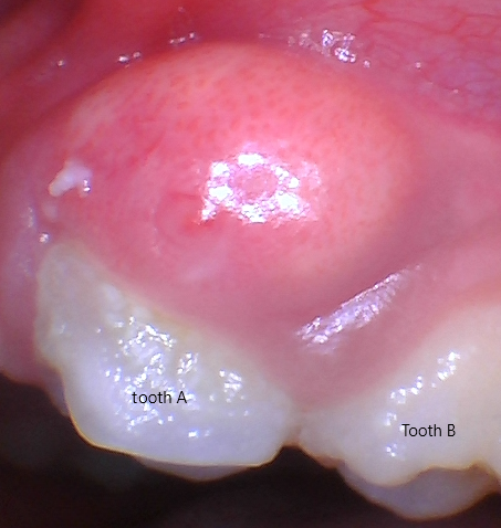 abscess 