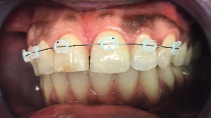 ceramic braces