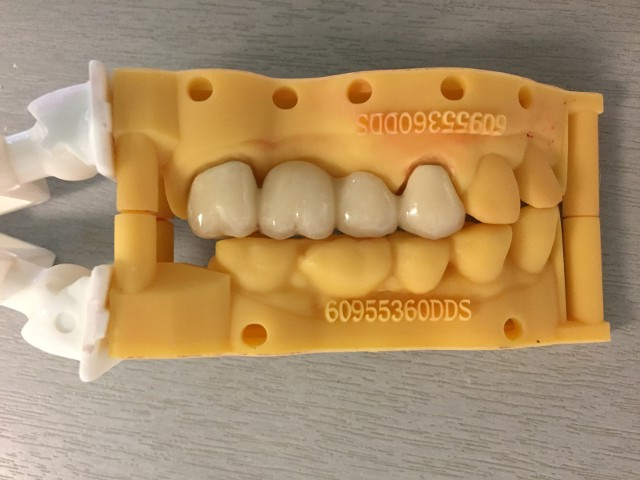 dental bridge dental bridge