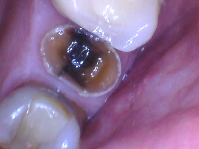 broken tooth