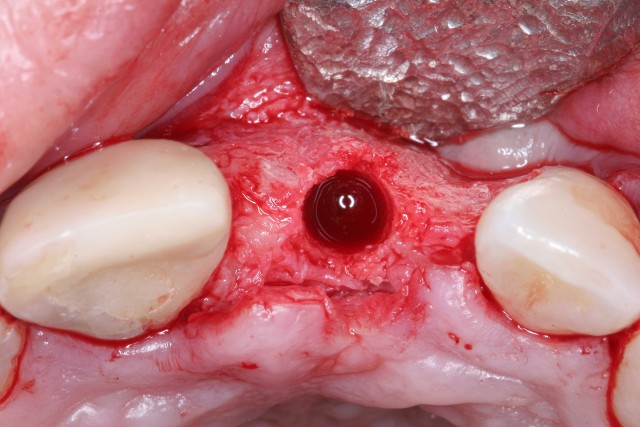 osteotomy