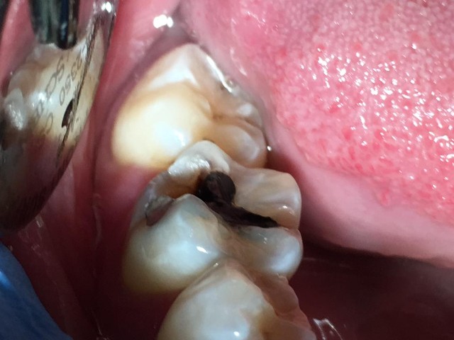 cavity