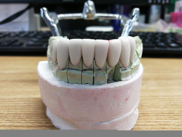 veneers