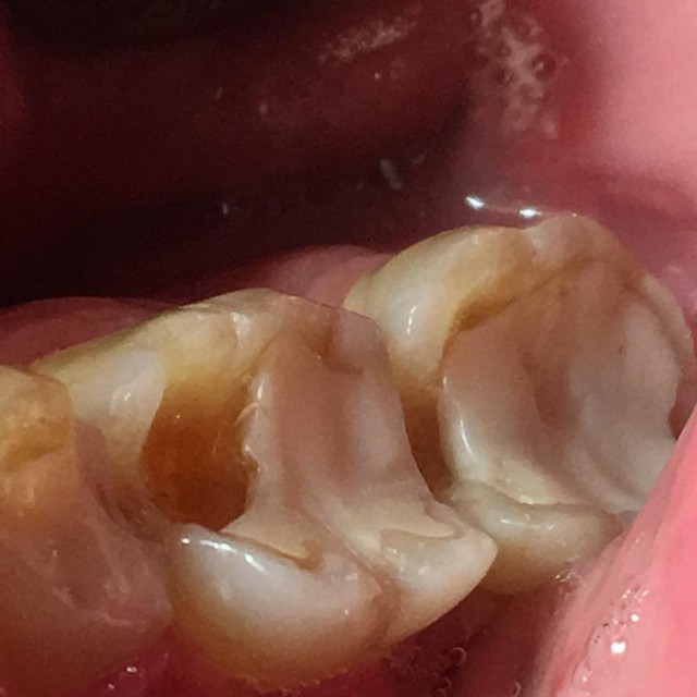 tooth grinding