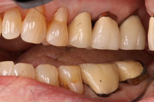 dental crowns