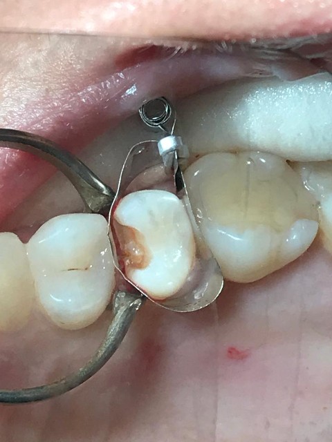 filling
