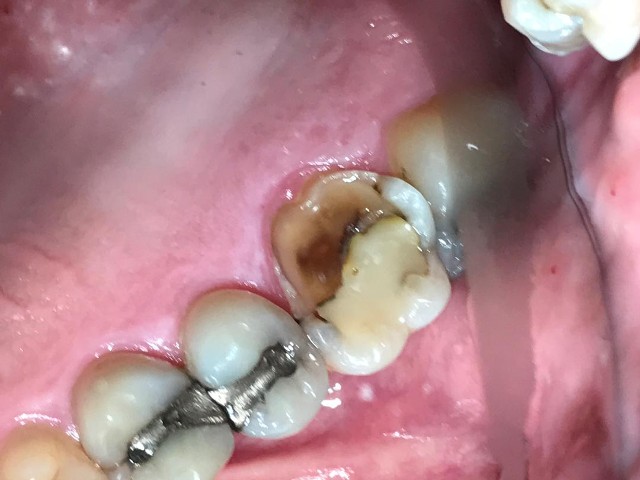 fractured tooth