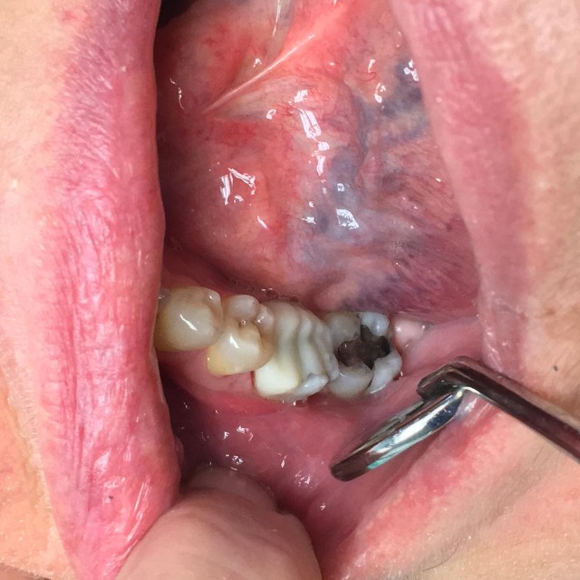 filling