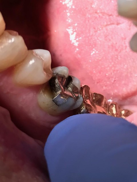 fracture
