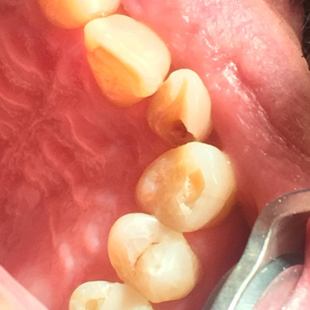 filling