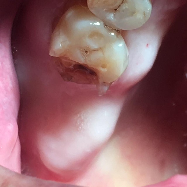 tooth fracture