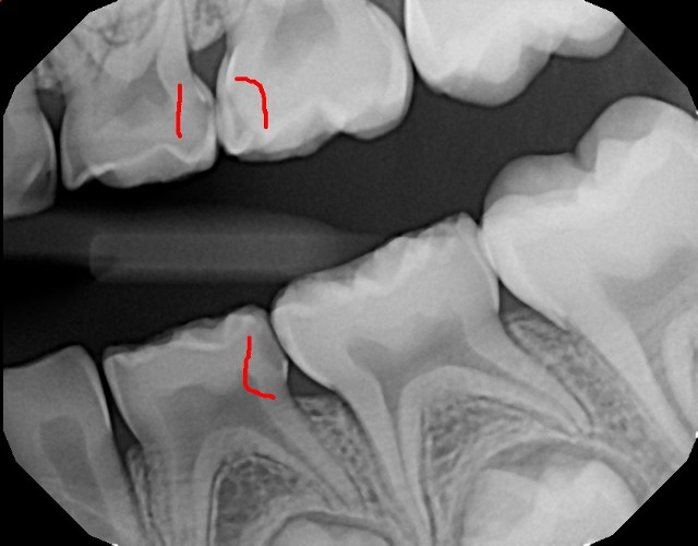 baby teeth