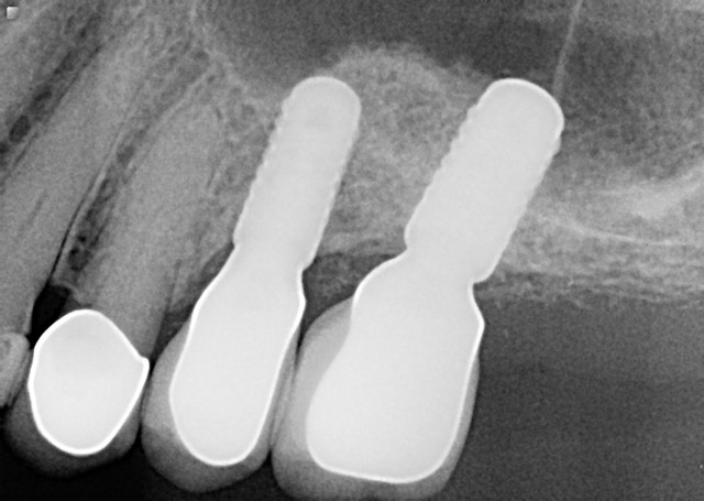 implant