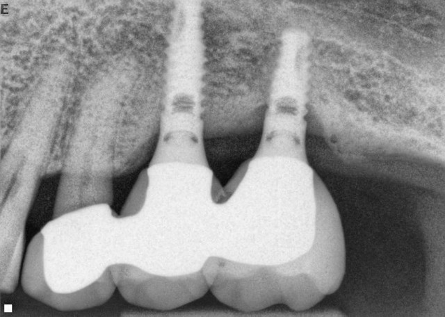 implants