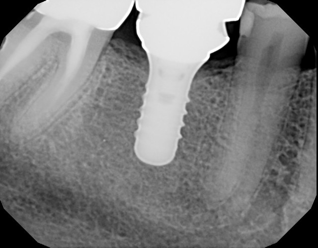 implants