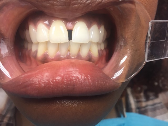 diastema