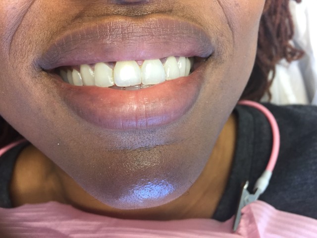 diastema after