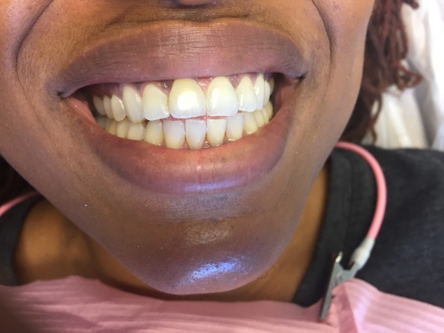 diastema after