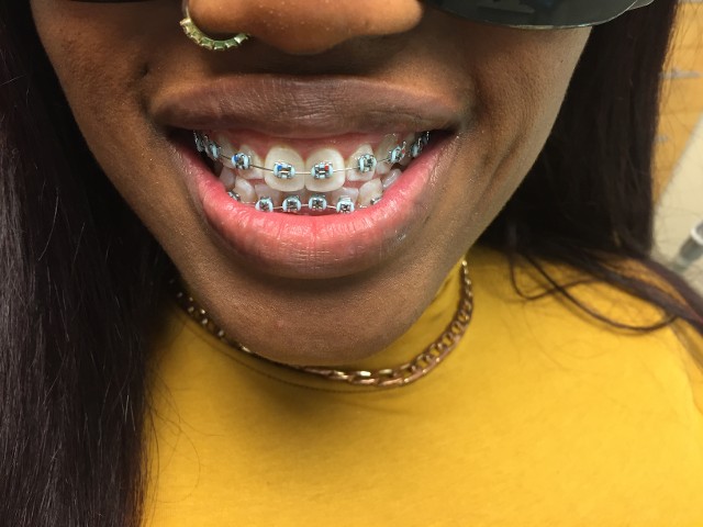Braces