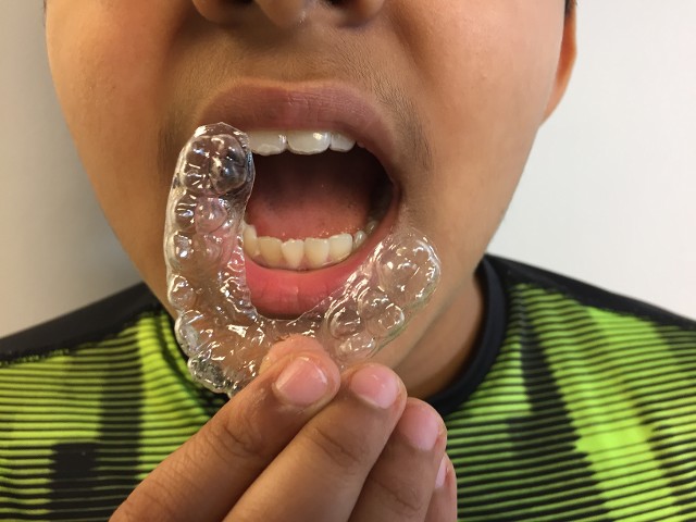 Aligners