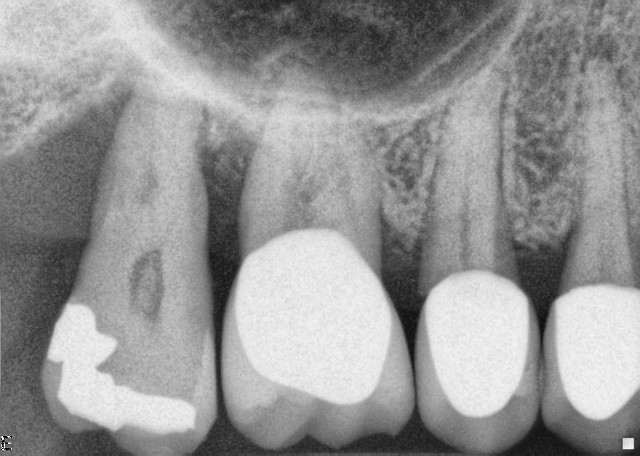 bone loss
