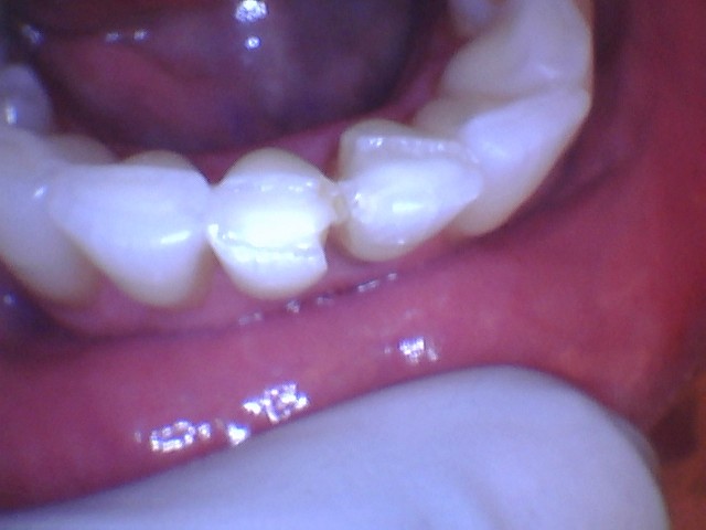 fillings