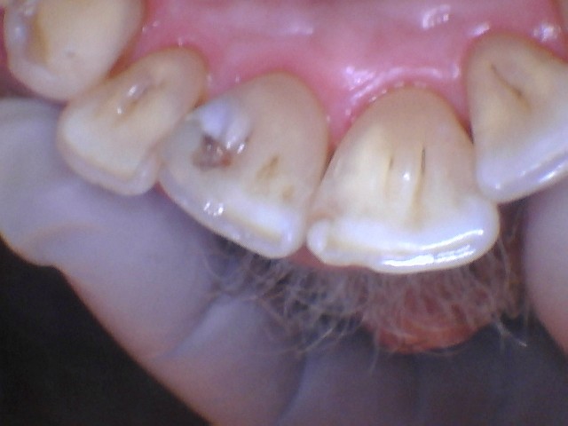 fillings