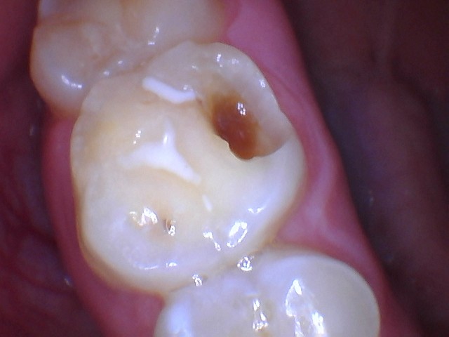 fillings