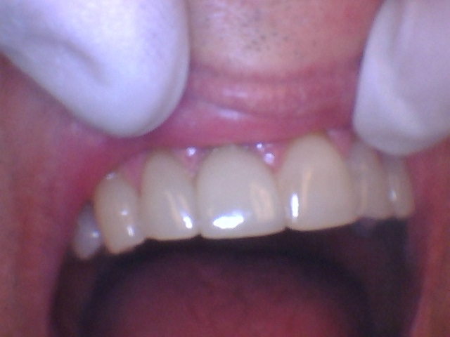 crown 