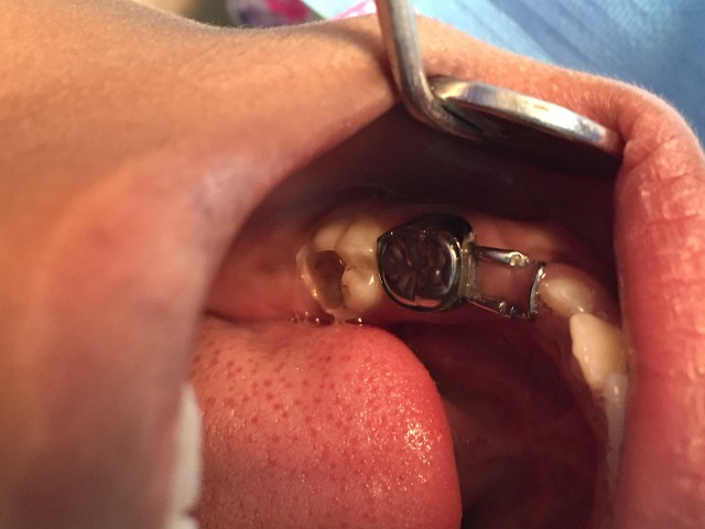band and loop