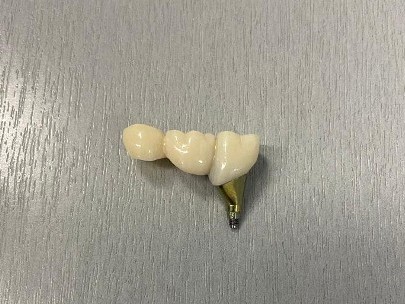 implants
