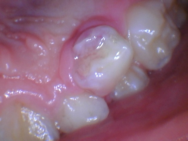 loose baby tooth