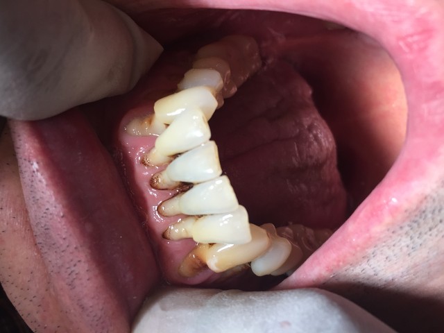 gum disease